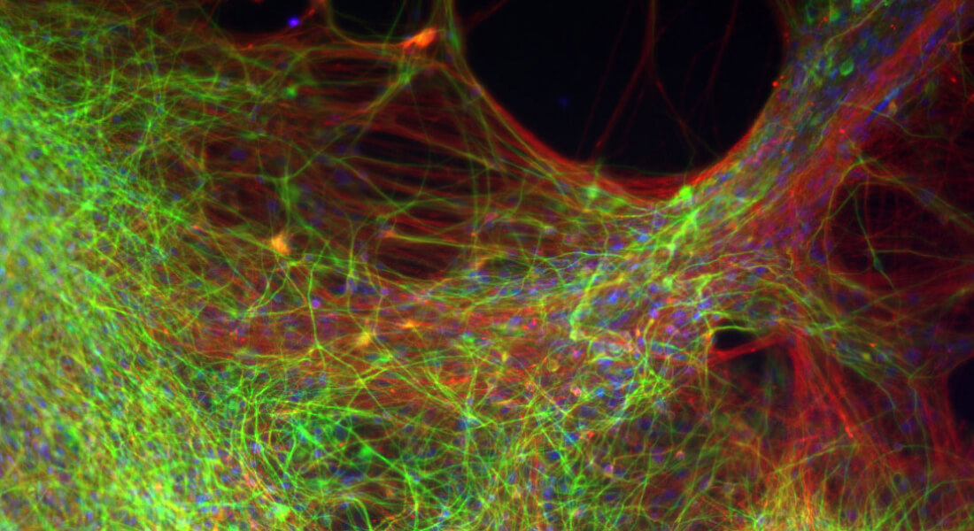 Dopamine-producing neurons that researchers from Lund University have grown in the laboratory from human embryonic stem cells.